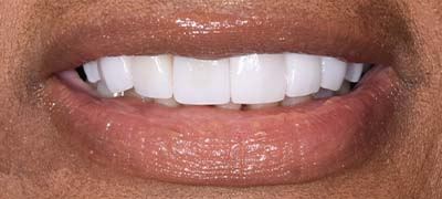 Closeup of perfectly aligned smile after clear braces orthodontics