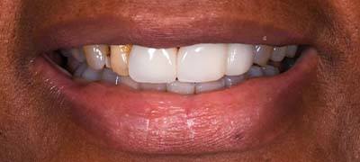 Closeup of smile with large gap between front teeth before clear braces orthodontics