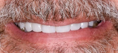 Closeup of brilliant smile after teeth whitening