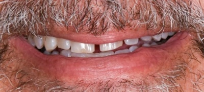 Closeup of yellowed smile before teeth whitening 
