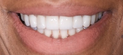 Closeup of brilliant smile after teeth whitening