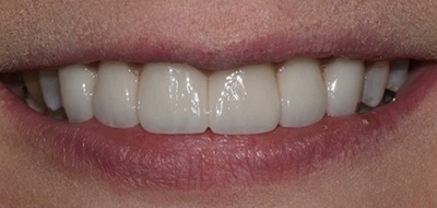 Closeup of perfectly aligned smile after clear braces orthodontics