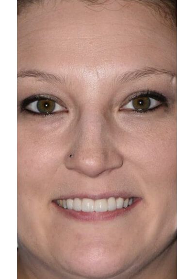 Woman with perfectly aligned smile after clear braces orthodontics