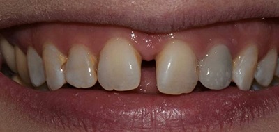 Closeup of smile with large gap between front teeth before clear braces orthodontics