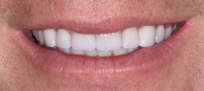 Closeup of brilliant smile after teeth whitening