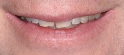 Closeup of yellowed smile before teeth whitening 