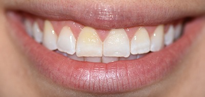 Closeup of yellowed and worn teeth before cosmetic dentistry