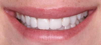 Closeup of brilliant smile after teeth whitening