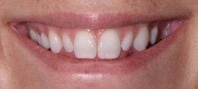 Closeup of yellowed smile before teeth whitening 