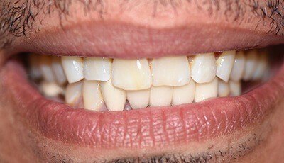 Crooked worn teeth before cosmetic dentistry and clear braces