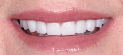 Closeup of brilliant smile after teeth whitening