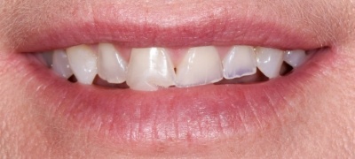 Closeup of yellowed smile before teeth whitening 