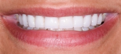 Closeup of brilliant smile after teeth whitening