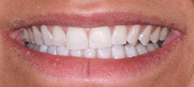 Closeup of yellowed smile before teeth whitening 