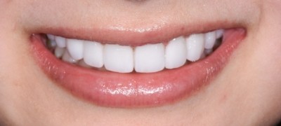 Closeup of brilliant smile after teeth whitening
