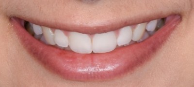 Closeup of yellowed smile before teeth whitening 