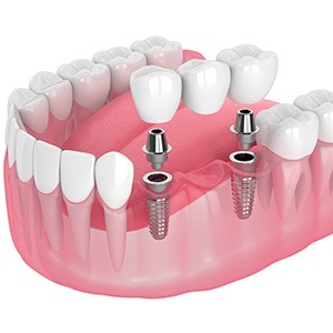 Dental bridge being attached to dental implants