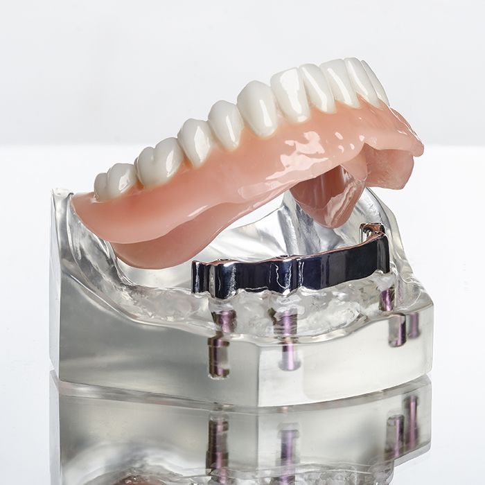 Model of implant supported dentures
