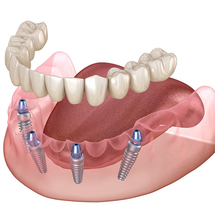 Implant dentures are dentures that secure in place via dental implants