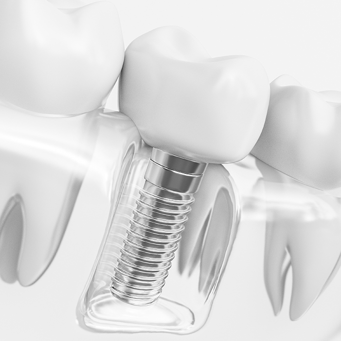 Animated implant supported dental crown