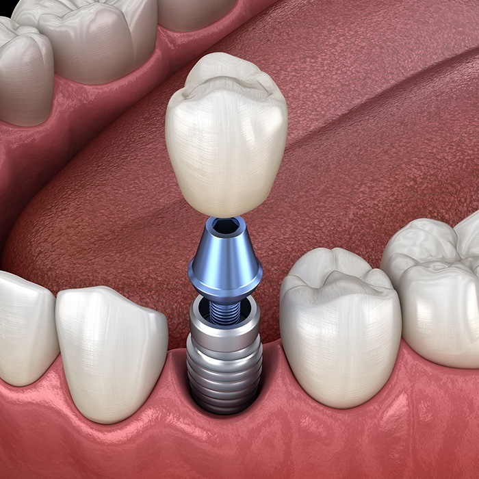 Animated implant supported dental crown