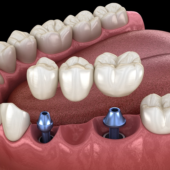 Animated implant supported fixed bridge