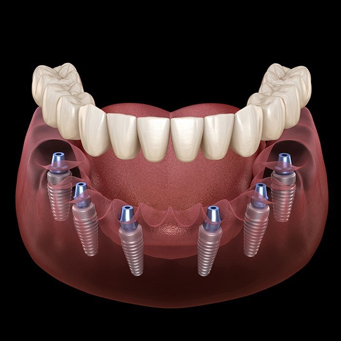 Animated implant supported denture