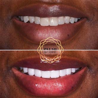 Smile before and after dental treatment in Frisco
