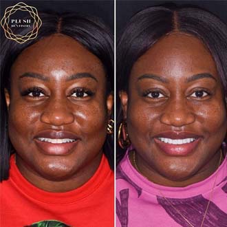 Before and after photo of Frisco dental patient smiling