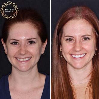 Before and after smile of dental patient in Frisco
