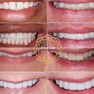 Friso dental patient smiling before and after treatment