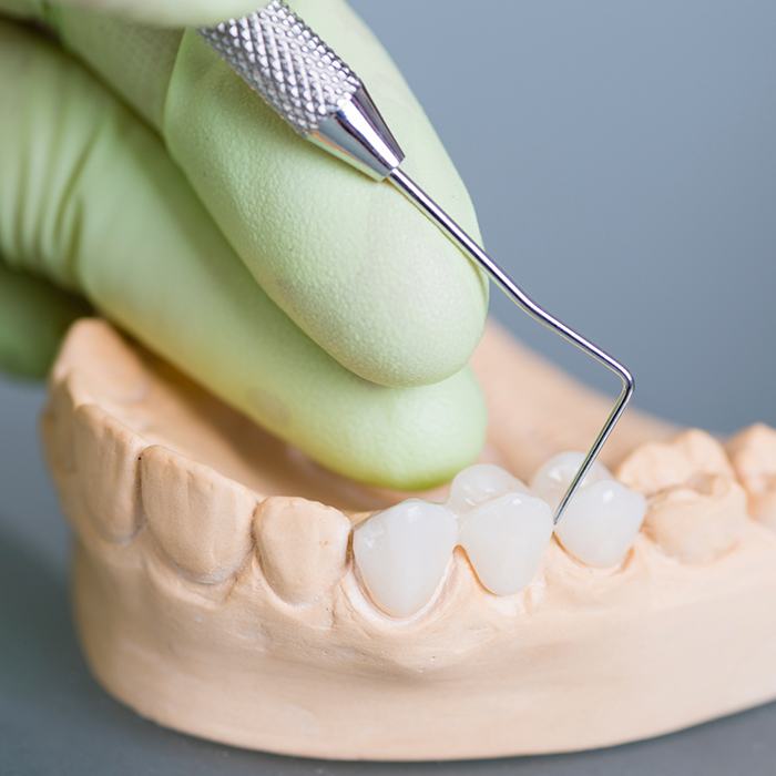 Model smile with fixed bridge restoration