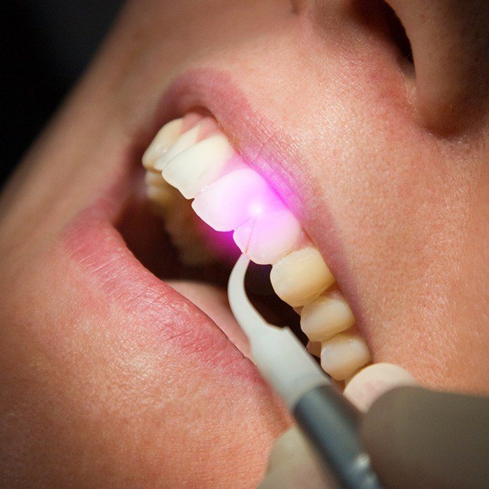 Closeup of smile during soft tissue laser periodontal treatment
