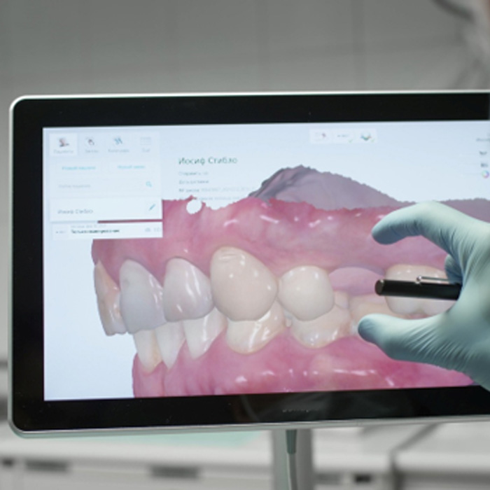 3D intraoral scan