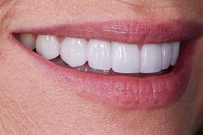 An up-close image of a woman’s teeth and her new veneers