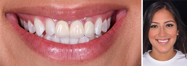 Smiling young woman before receiving porcelain veneers in Frisco