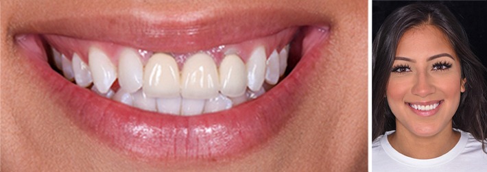 A young woman standing outside during the fall months and smiling after receiving veneers in Frisco