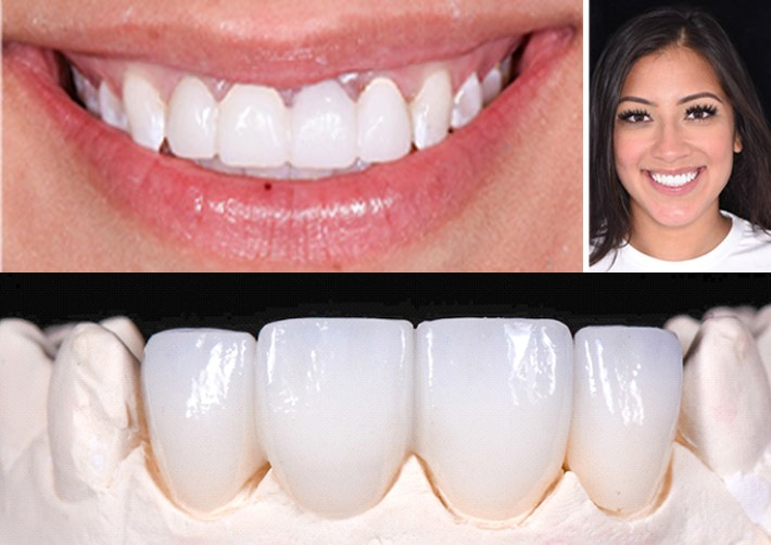 Smiling, pretty young woman wearing temporary porcelain veneers