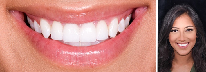 Smiling young woman with final set of porcelain veneers