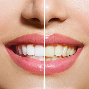 Close-up of woman’s smile before and after teeth whitening