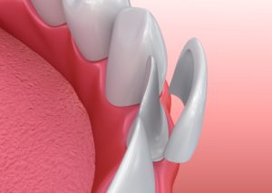 Avoid dangerous dental trends with veneers