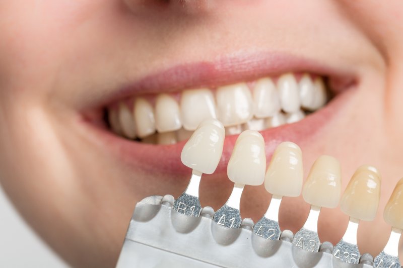 dentist color matching dental veneers