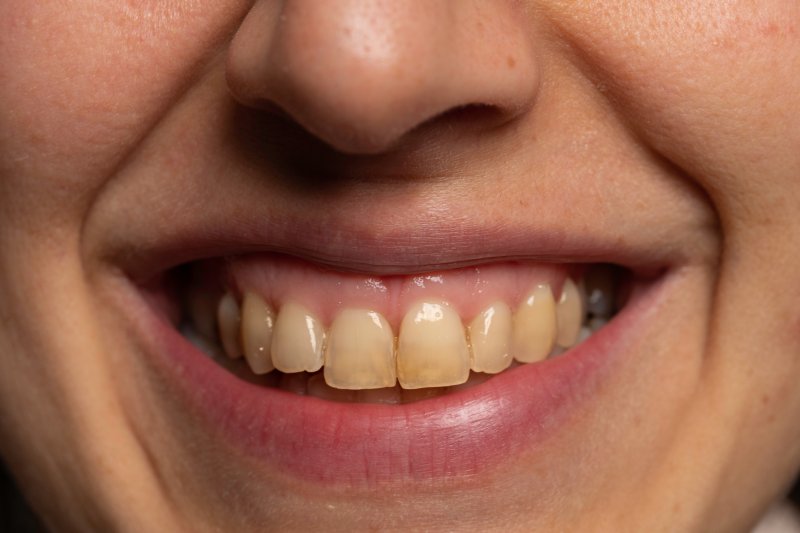 Yellow teeth close-up