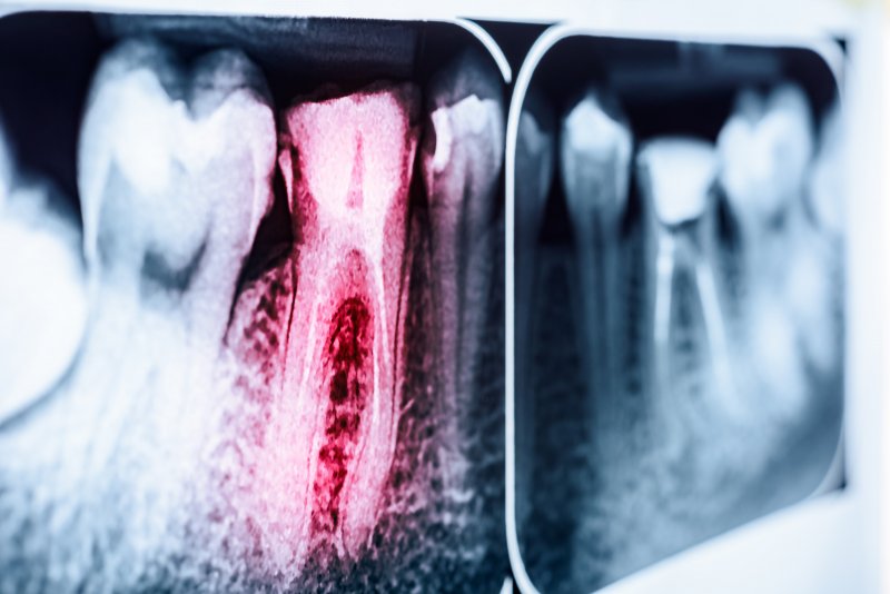 A highlighted picture of a tooth that needs a root canal treatment