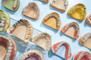 different types of dental restorations on plaster models of mouths